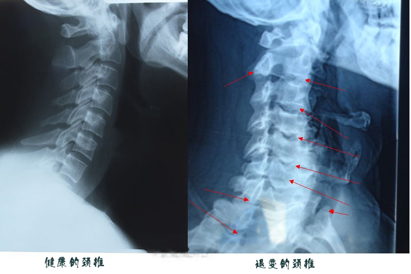 35岁男子躺床上玩手机颈椎退化如70岁老人