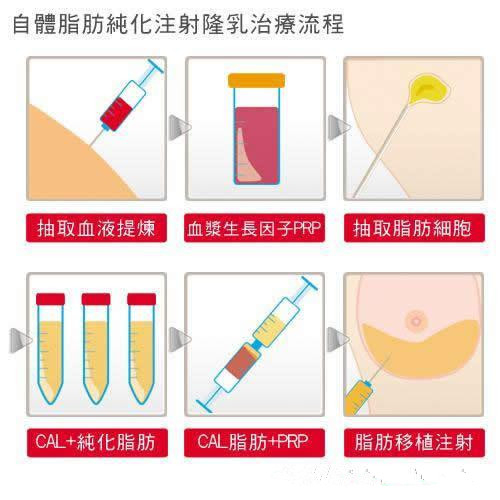 洛阳王静自体脂肪丰胸超全图解,再也不用担心看不懂了