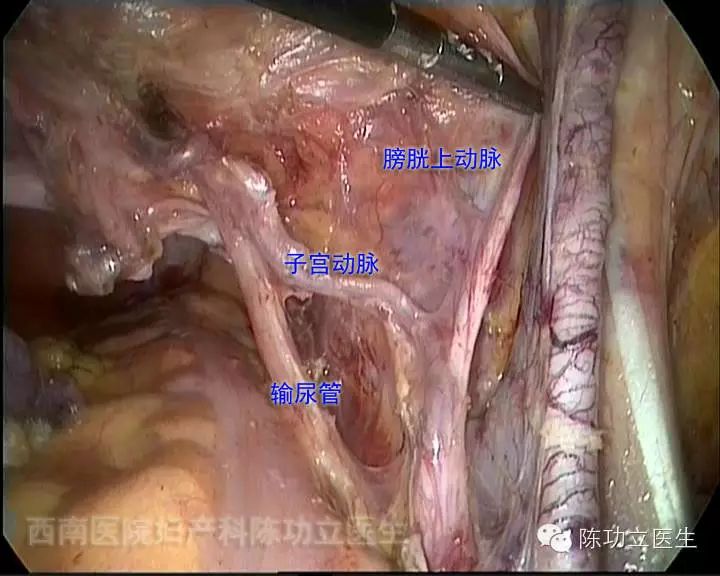 收藏!妇产科手术解剖图谱之血管解剖