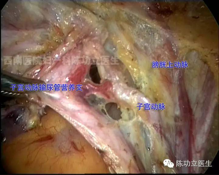 收藏!妇产科手术解剖图谱之血管解剖