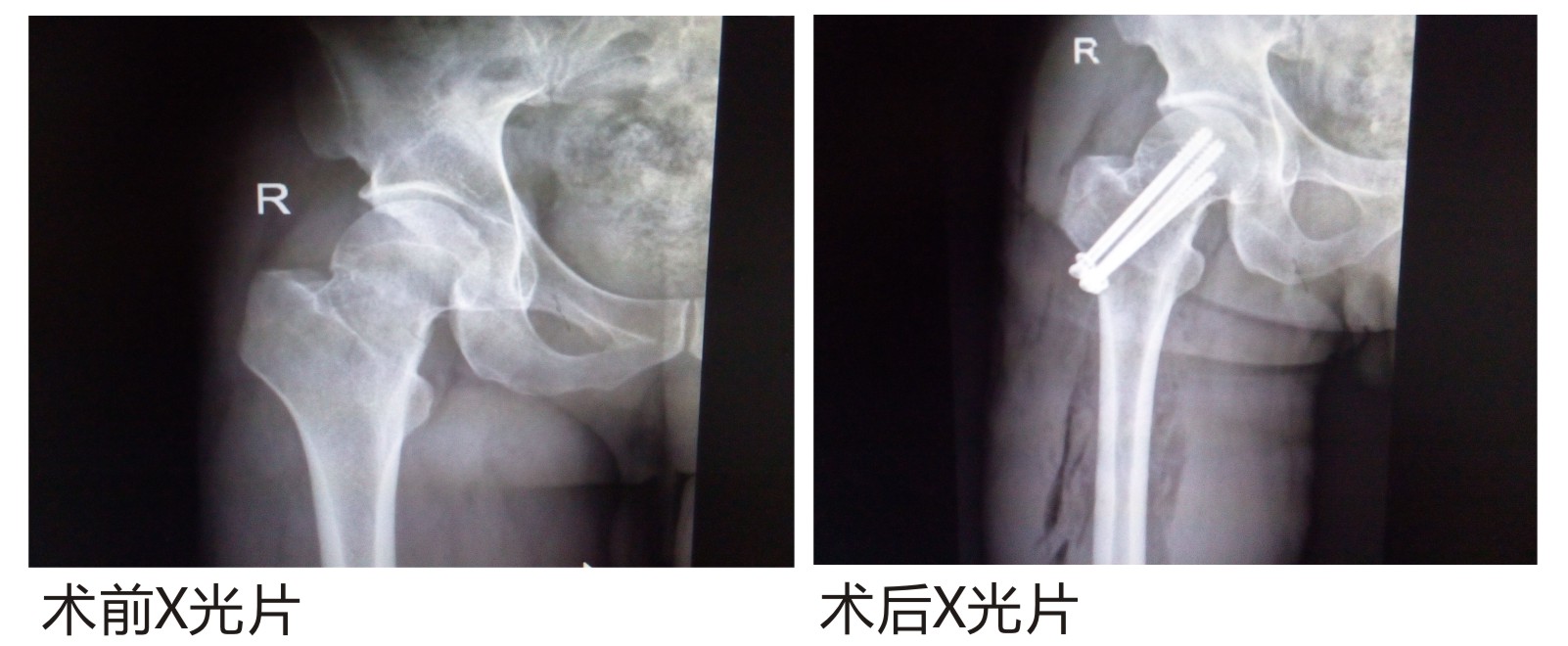 广药三院骨科手术患者案例摘要