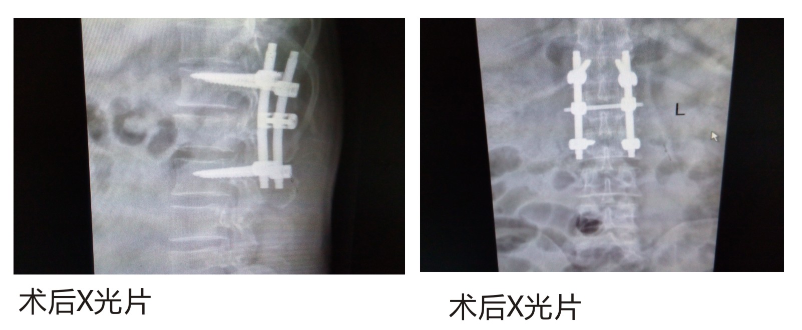 广药三院骨科手术患者案例摘要