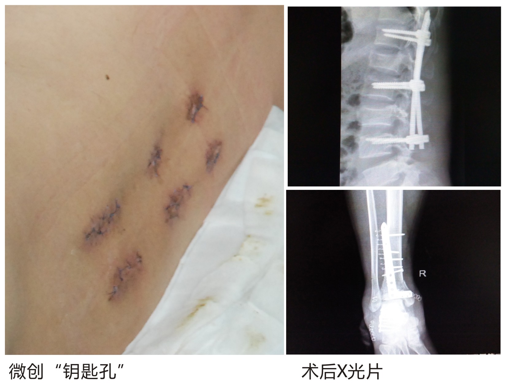 广药三院骨科手术患者案例摘要