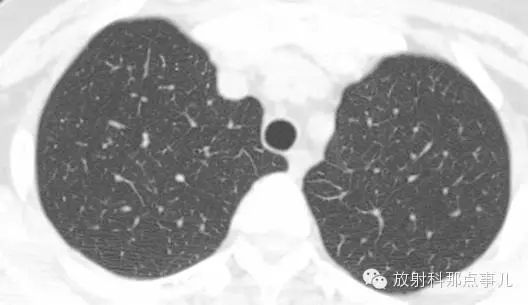 【影像诊断】hrct肺间质性改变的表现及意义