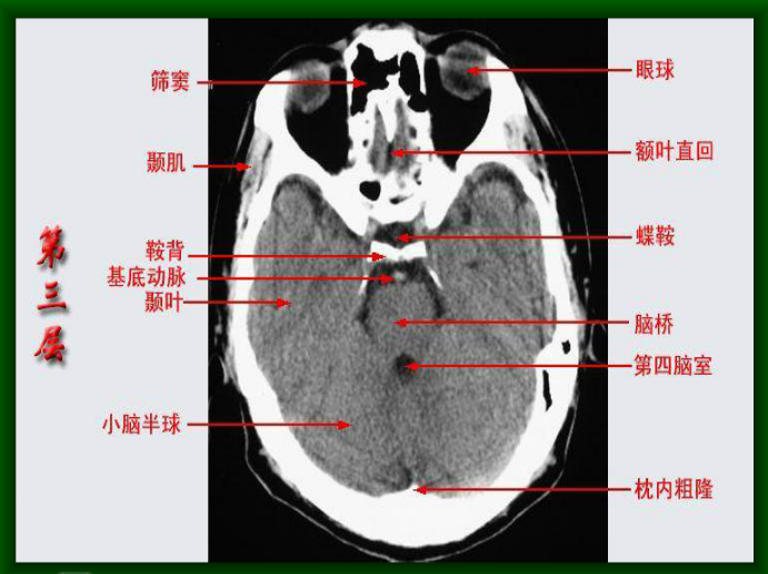 康复临床必备技能:头颅ct解剖图片汇总