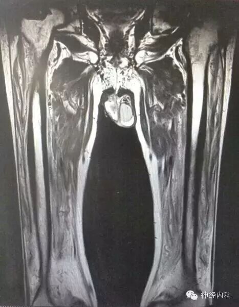 双大腿肌肉mri