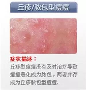 丘疹属于一般性皮肤损害,正常情况下不会留下疤痕,而脓包是由于丘疹