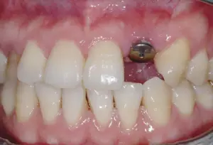牙科小知识丨种植七步骤，原来种植牙是这样种的