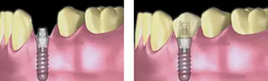 牙科小知识丨种植七步骤，原来种植牙是这样种的