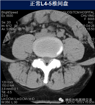 腰椎间盘膨出突出椎管狭窄ct诊断