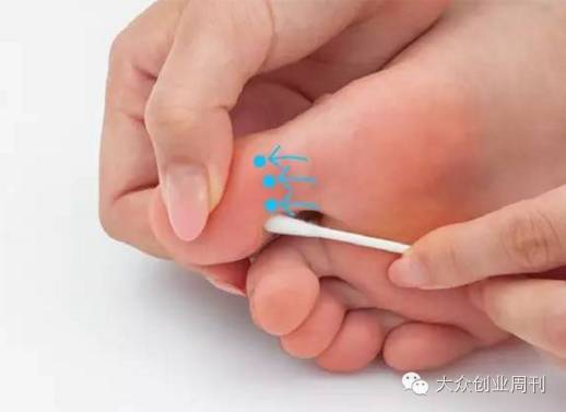 一根棉签解决身上各种酸痛,立马感觉无比舒畅!