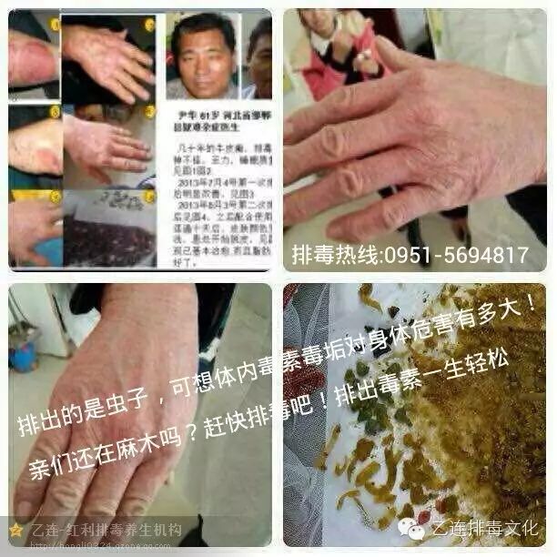 【排毒文化】乙连各种虫类,肿瘤-癌症患者特殊排毒案例