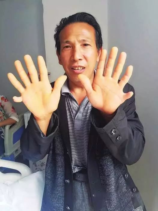家族特殊"双生"遗传 开阳一男子 长了4个肾