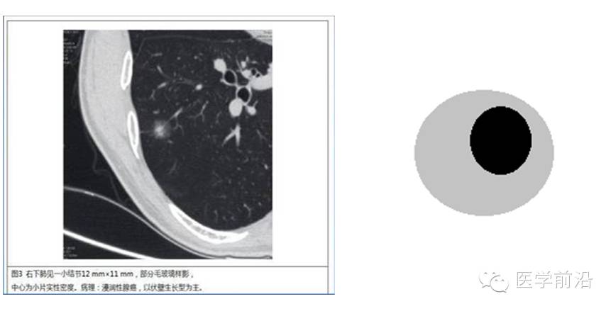 2,部分磨玻璃结节或混合性非实性结节毛玻璃成分为均匀的磨砂状阴影