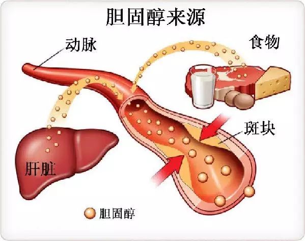 近年来,我国心脑血管疾病的发病率越来越高,究其原因,和"坏"胆固醇