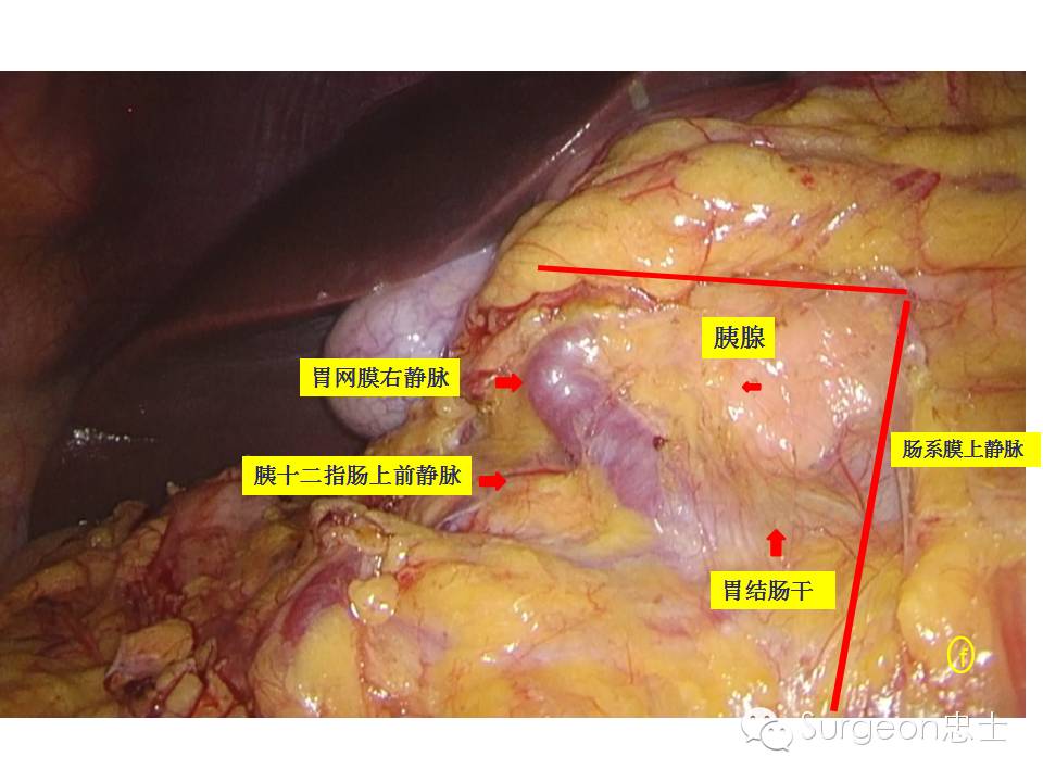 以胰腺为解剖标识点显露胃结肠干各属支血管,暂不予以处理,待内侧会师