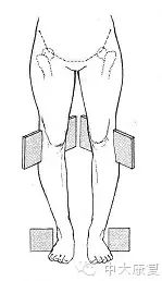 二,一半以上o型腿的人只是单纯膝下胫骨内翻,这种人特点就是膝盖