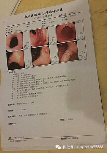 惊心动魄50天～我的胃癌康复记!---毛淑华