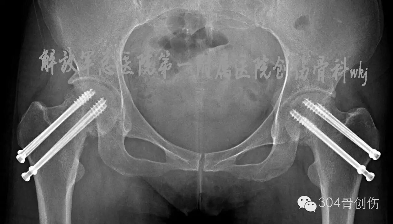 怀孕期间会骨折吗?-怀孕期
