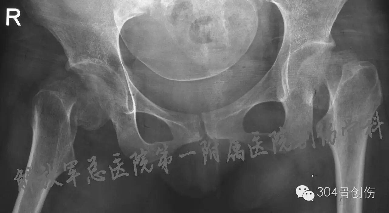 怀孕期间会骨折吗?-怀孕期