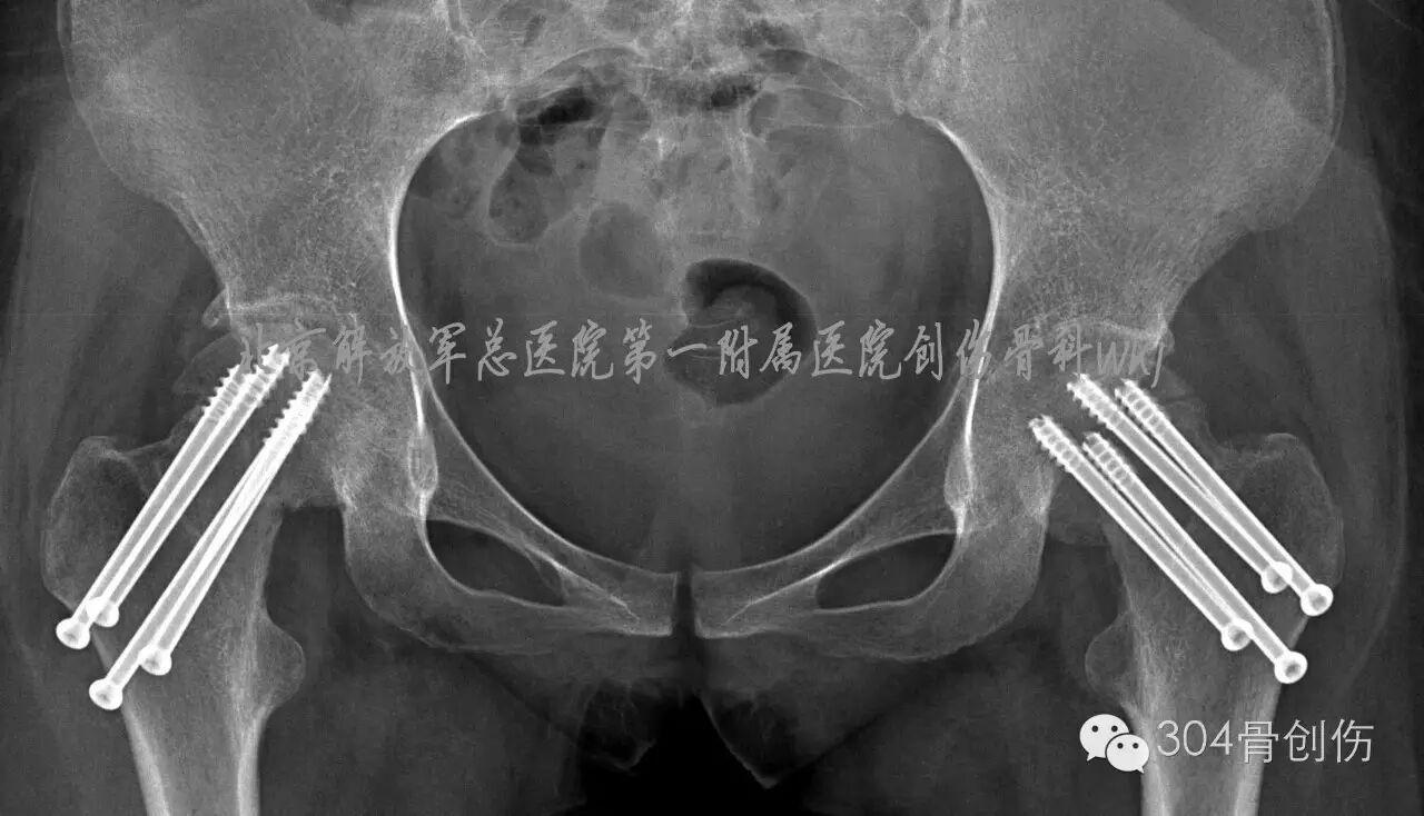 怀孕期间会骨折吗?-怀孕期