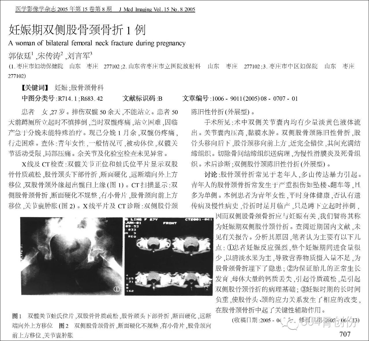 怀孕期间会骨折吗?-怀孕期