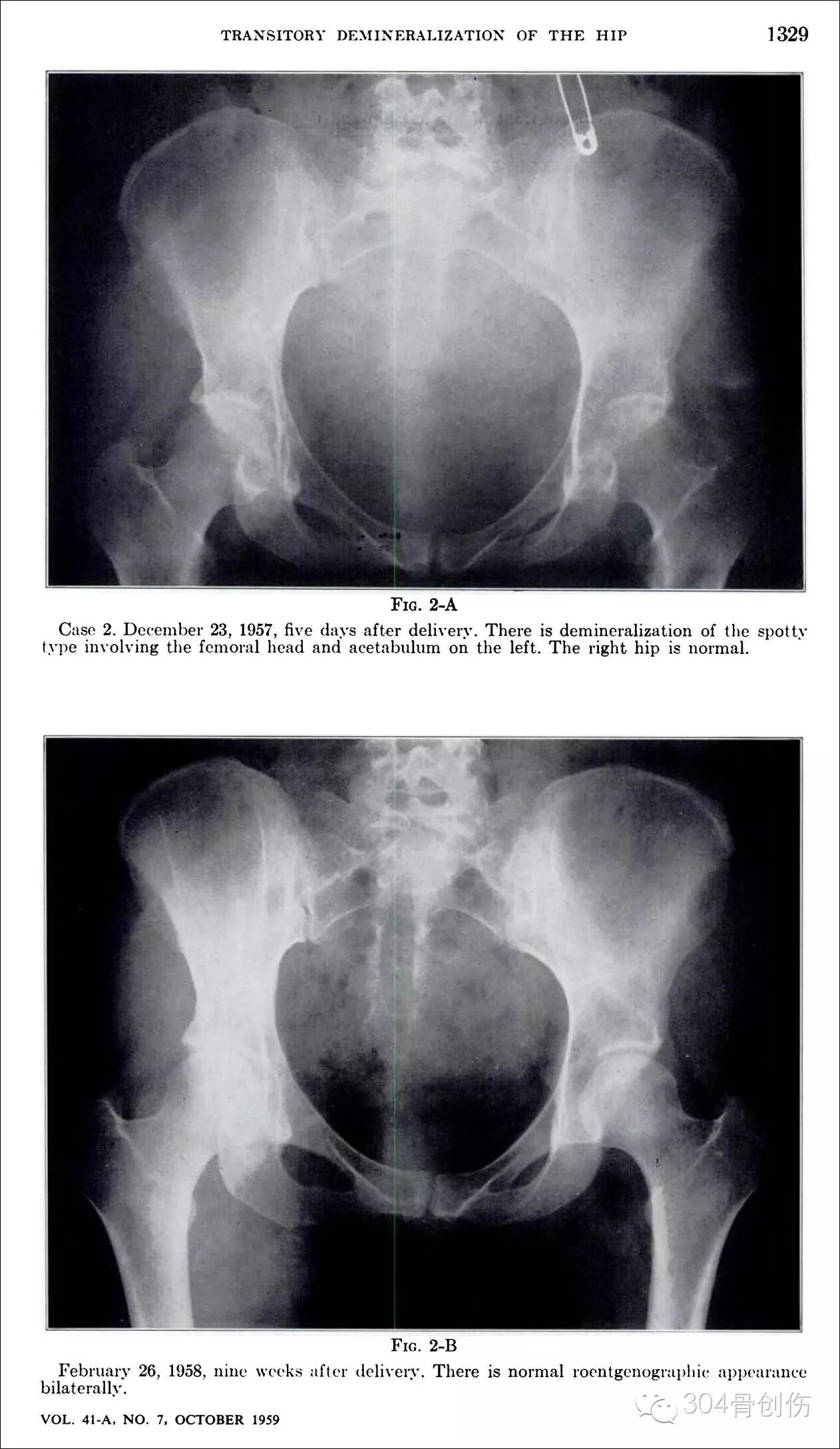 怀孕期间会骨折吗?-怀孕期