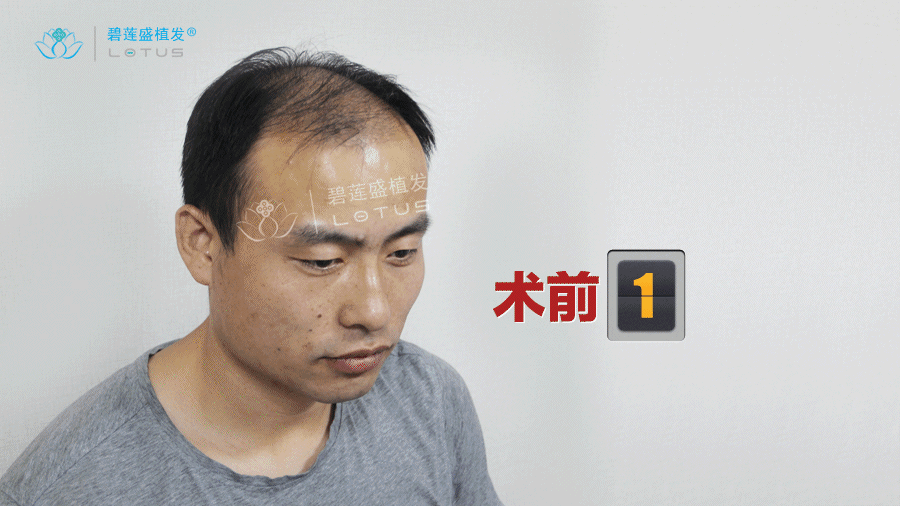 3分钟看懂植发,你不得不懂的植发问题答案尽在此!