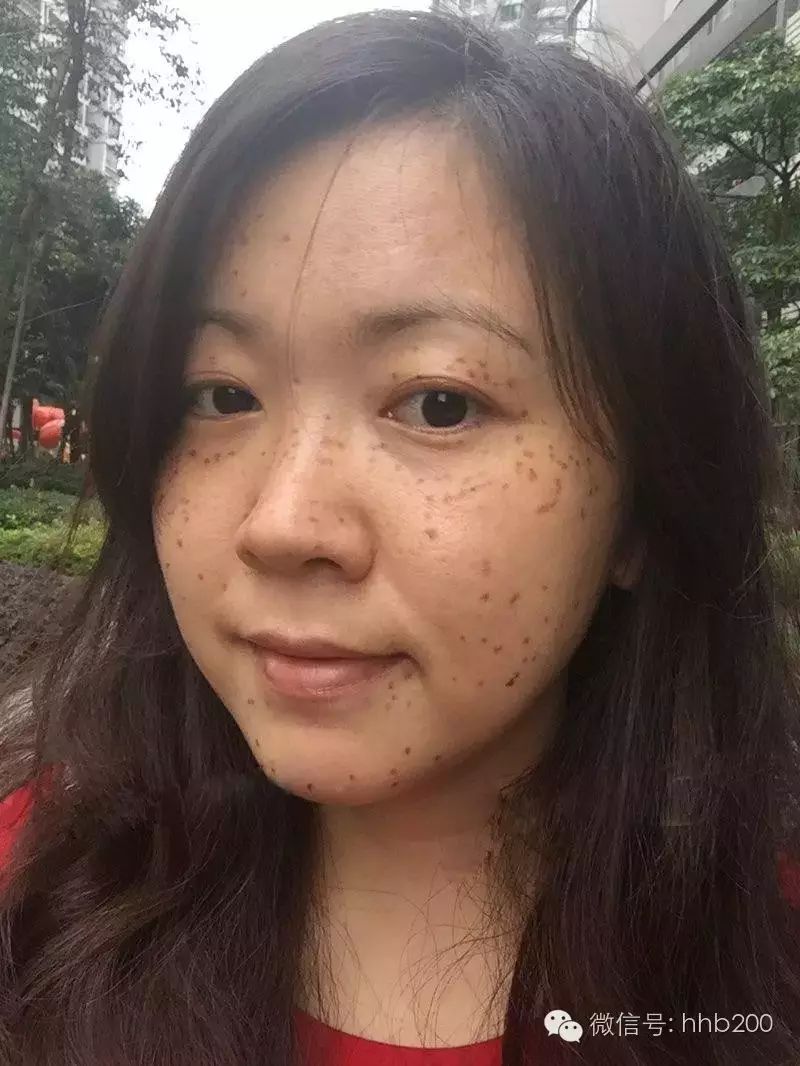心理上似乎已经比较接受术后的麻子脸了,今天出门都敢不戴墨镜了