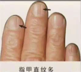 指甲纵纹——神经衰弱