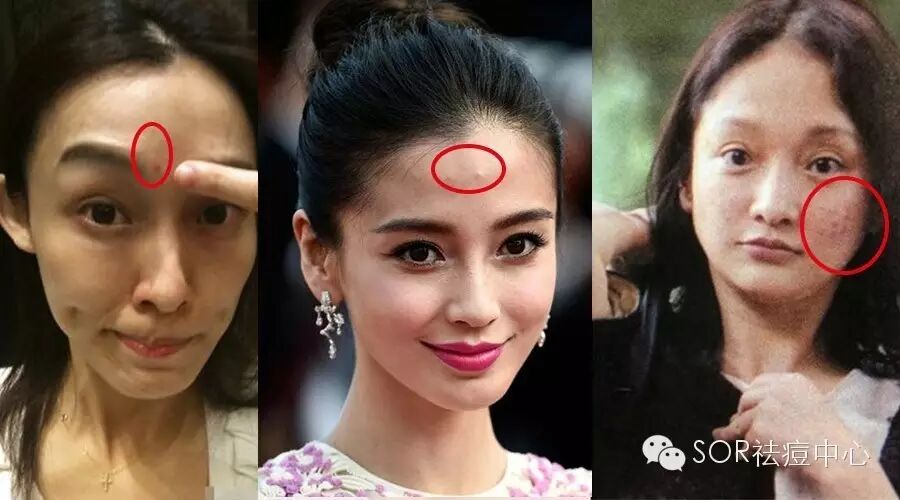 baby杨幂刘诗诗孙俪八大女明星长痘吓坏人,祛痘变美人