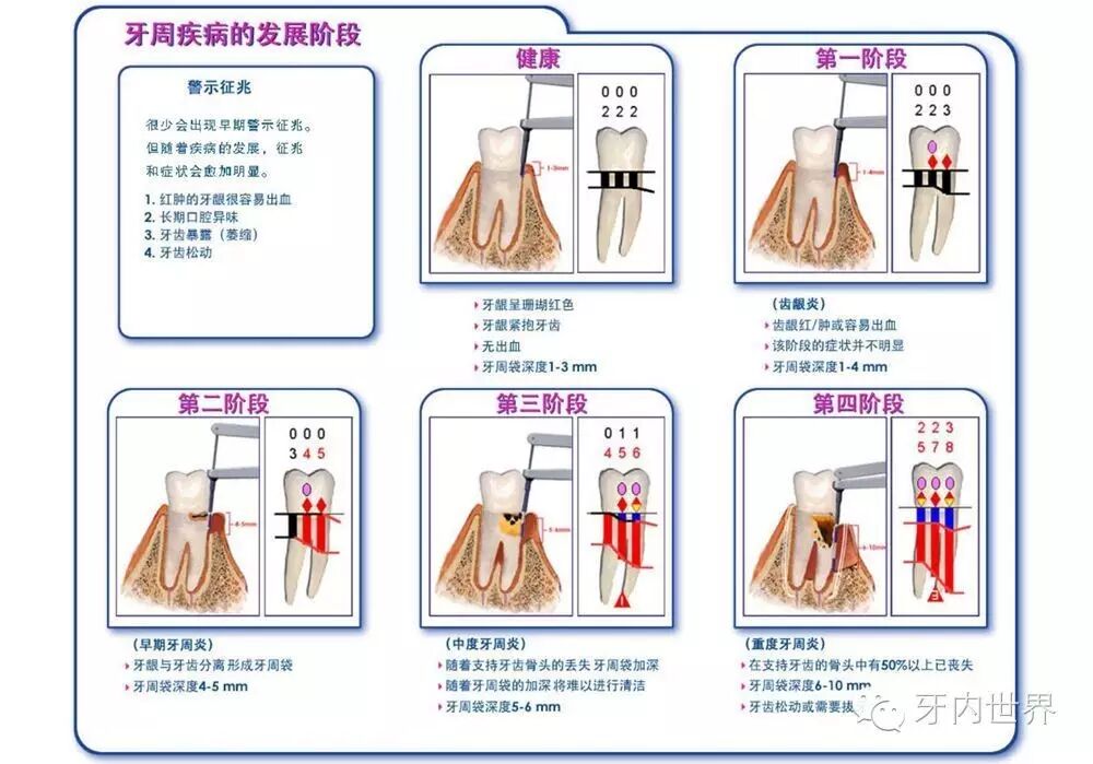 口腔什么是探针你牙周健康吗？做个牙周探针检查，一目了然！-上海聚慕医疗器械有限公司