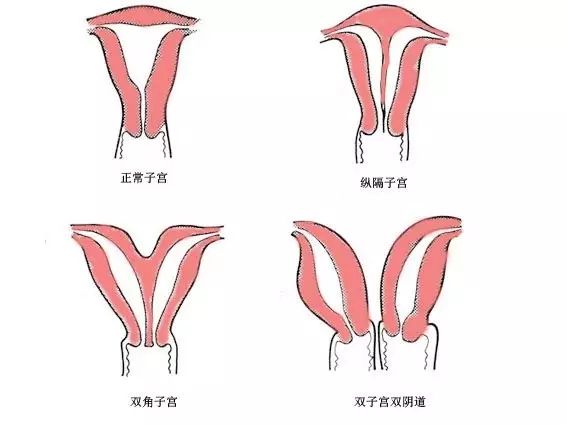 医学科普|你的子宫是"一室户"还是"二室户"?