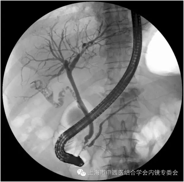 消化内镜专业护理系列-经内镜逆行胰胆管造影术(ercp)护理