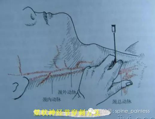 星状神经节阻滞