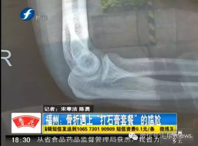 福州一男子手臂骨折打石膏，可是医院却要收取“打石膏套餐费”！好心塞.......
