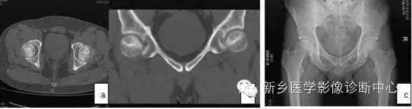 千万别把这10种病变都诊断成股骨头坏死