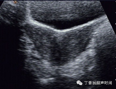 双角子宫和不完全纵隔子宫的超声鉴别