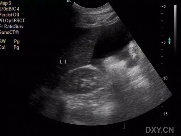「二胎来了」超声系列之:卵巢过度刺激综合征-怀孕期