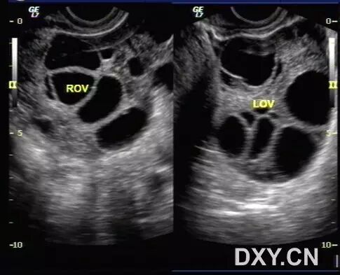 「二胎来了」超声系列之:卵巢过度刺激综合征-怀孕期