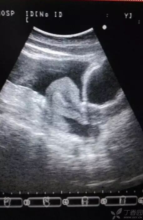 「二胎来了」超声系列之:卵巢过度刺激综合征-怀孕期