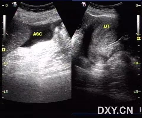「二胎来了」超声系列之:卵巢过度刺激综合征-怀孕期