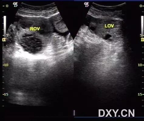 「二胎来了」超声系列之:卵巢过度刺激综合征-怀孕期