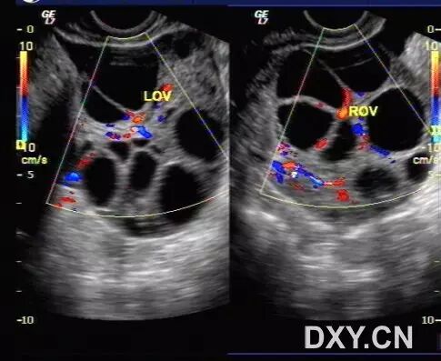 「二胎来了」超声系列之:卵巢过度刺激综合征-怀孕期