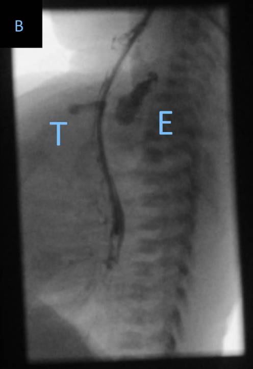 怎么拔鼻腔引流管胃管术（二）_https://www.jmylbn.com_新闻资讯_第50张