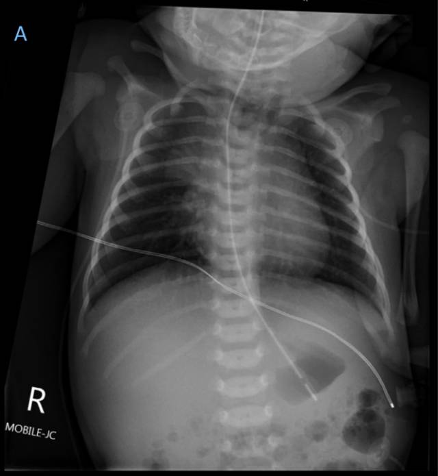 怎么拔鼻腔引流管胃管术（二）_https://www.jmylbn.com_新闻资讯_第49张