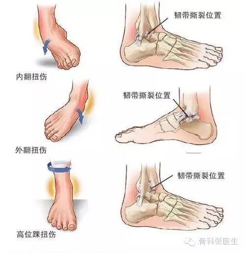 不同踝关节扭伤类型及韧带损伤位置