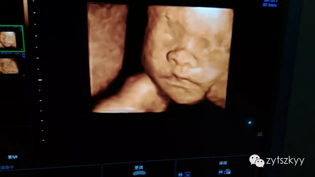 原来怀孕不做四维彩超会这么后悔(中医特色专科医院健康科普节目二)-怀孕期