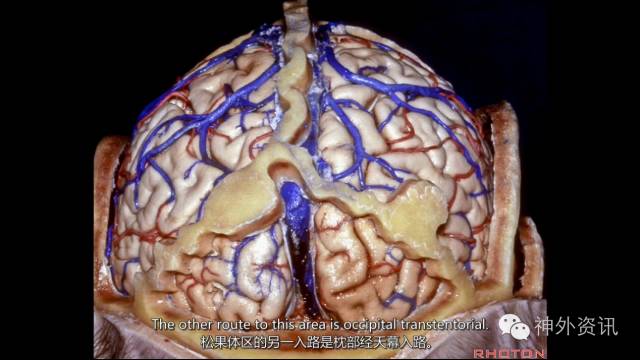 枕部经天幕入路暴露松果体区颞叶内侧面解剖经颞叶-颞角脉络裂暴露环