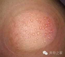 拔上一罐，病去一半！